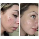 سرم آزلائیک اسید ۱۰ ٪ هیالورون آنوا تسکین دهنده و ضد التهاب